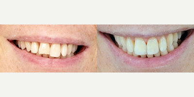 Dental Bonding before and after photo