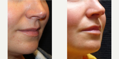 Dermal Fillers before and after photo