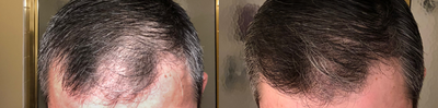 PRP for Hair Loss before and after photo