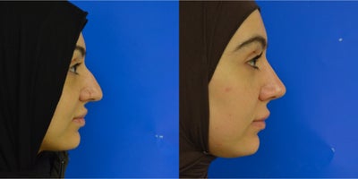 Rhinoplasty before and after photo