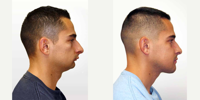 Genioplasty before and after photo