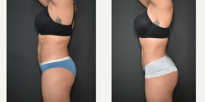 Brazilian Butt Lift before and after photo