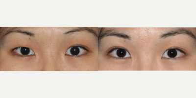 Eyelid Surgery before and after photo