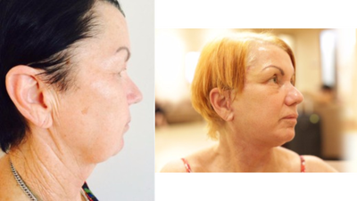 Facelift before and after photo