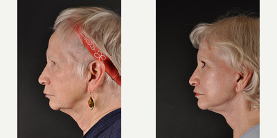 Facelift before and after photo