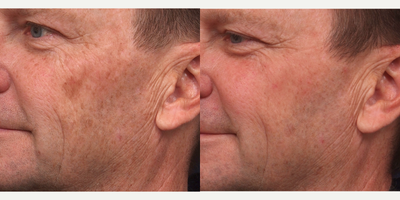 Fraxel Laser before and after photo