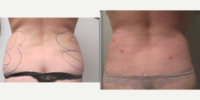 Laser Liposuction before and after photo