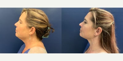 Liposuction before and after photo