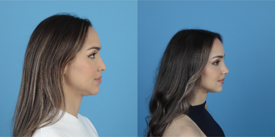 Revision Rhinoplasty before and after photo