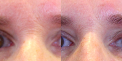 ThermiSmooth Face before and after photo