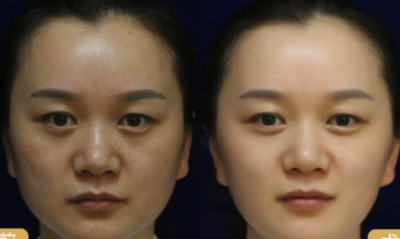 Ultherapy before and after photo