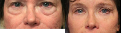 Facial Fat Transfer before and after photo