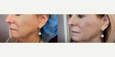 Laser Resurfacing before and after photo