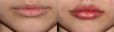 Restylane before and after photo