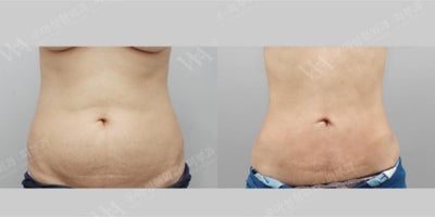 Tummy Tuck before and after photo