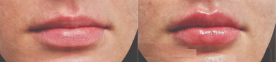 Dermal Fillers before and after photo