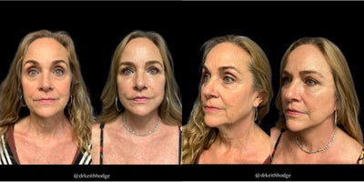 Eyelid Surgery before and after photo