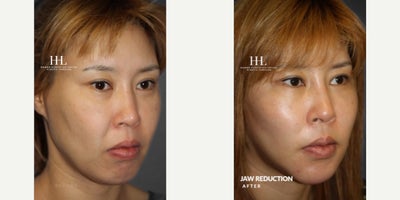 Jaw Reduction before and after photo