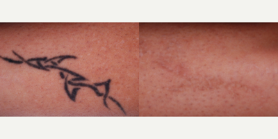 PicoWay before and after photo