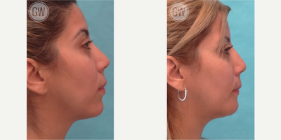 Rhinoplasty before and after photo