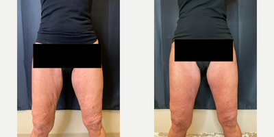 Skin Tightening before and after photo