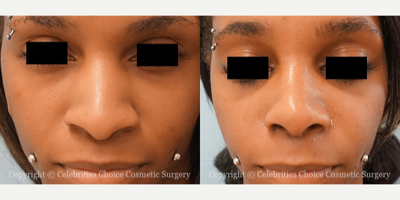 African American Rhinoplasty before and after photo