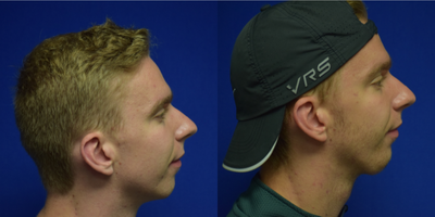 Chin Implant before and after photo