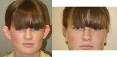 Ear Surgery before and after photo