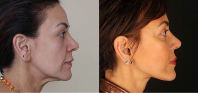 Facelift before and after photo
