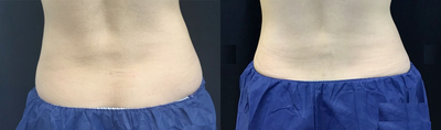CoolSculpting before and after photo