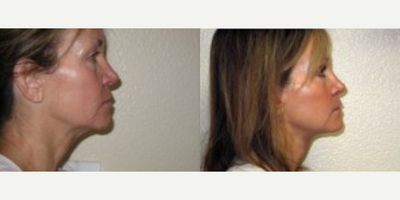 Facelift before and after photo