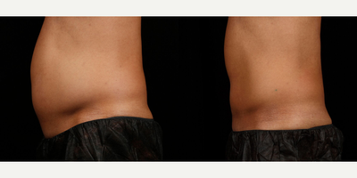 SculpSure before and after photo