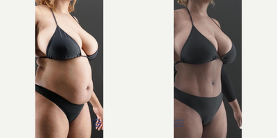 Abdominal Etching before and after photo