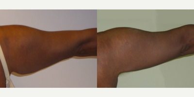 Arm Lift before and after photo