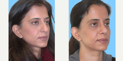 Asian Rhinoplasty before and after photo