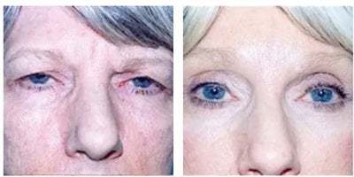 Eyelid Surgery before and after photo