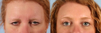 Brow Lift before and after photo