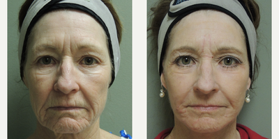 Facelift before and after photo
