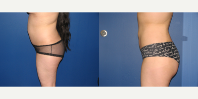 Liposuction before and after photo