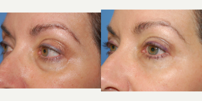 Restylane before and after photo