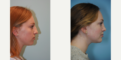 Rhinoplasty before and after photo