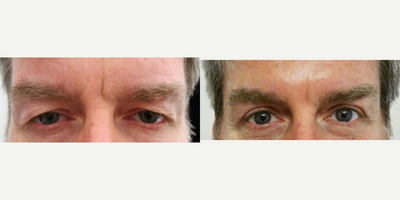 Eyelid Surgery before and after photo