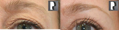 Laser Resurfacing before and after photo
