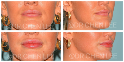 Lip Fillers before and after photo