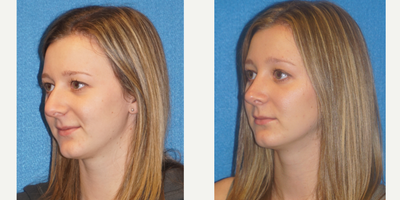 Rhinoplasty before and after photo