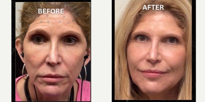 Dermal Fillers before and after photo