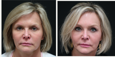 Brow Lift before and after photo