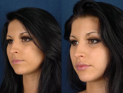 Restylane before and after photo