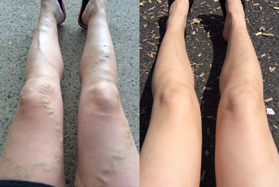 Sclerotherapy before and after photo