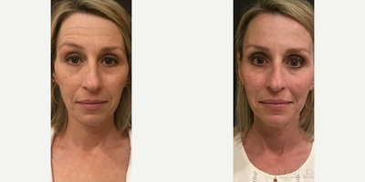 Botox before and after photo